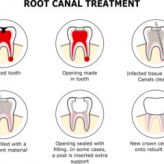 Root-Canal-Treatment (1)